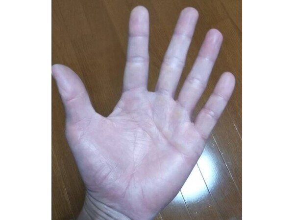 スイングの弱点がわかる 手足のマメをチェックしてみましょう スポーツナビdo スイングの弱点がわかる 手足のマメをチェックしてみましょう スポーツナビdo